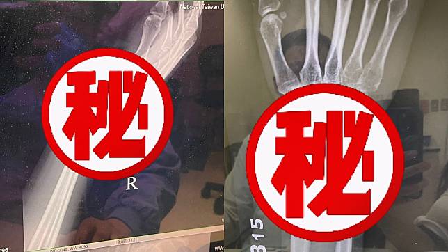 李培禎手術前Ｘ光照（左），術後放入鋼板Ｘ光照（右）。艾迪昇傳播事業有限公司提供