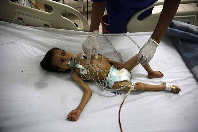 葉門西部沙那的醫院內，護士正在照顧一名營養不良的小男孩（AP）