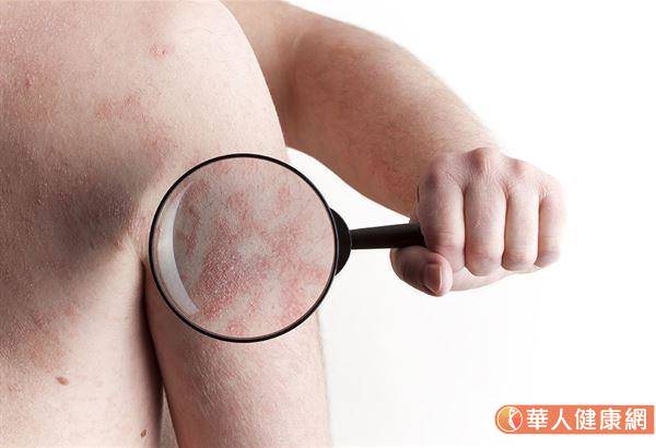 一旦乾癬變得愈來愈嚴重，就要小心可能併發為乾癬性關節炎的風險。