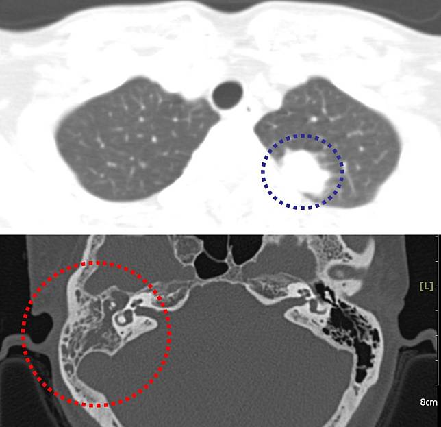 圖上電腦斷層顯示左側上肺葉有腫瘤（藍圈處），下圖右側顳骨氣房及中耳腔滿是液體（紅圈處）。（醫師陳建志提供）