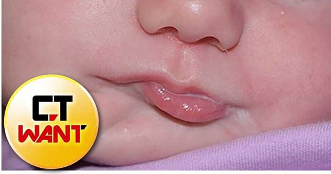 可愛女嬰臉上驚長「2嘴巴」　喝奶另一個小舌頭會一起動
