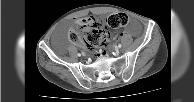 男突腹部劇痛竟是長期便秘大腸破裂　滿肚子大便險送命