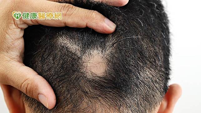 圓禿不只會發生在頭部，眉毛、鬍子等處都有可能會出現毛髮異常掉落的情形。