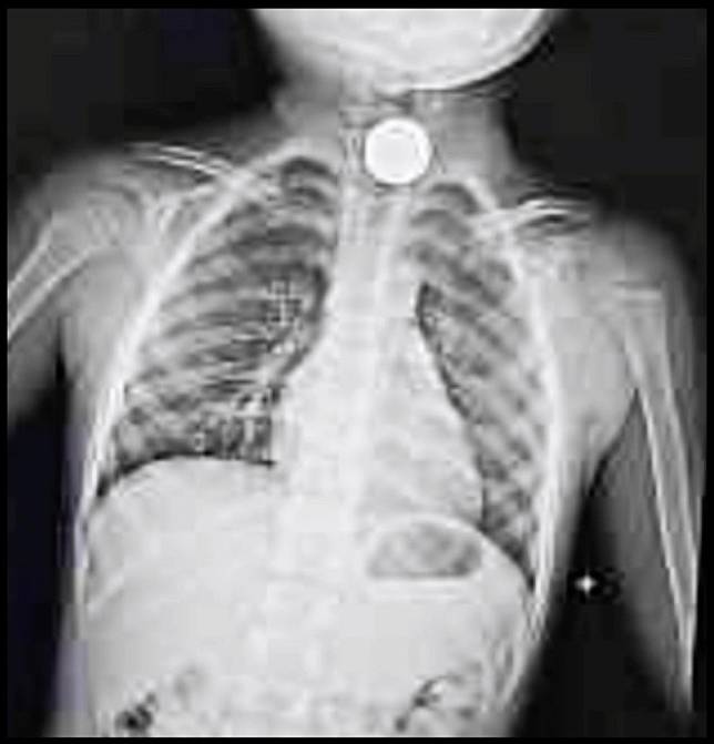 【誤吞異物】X光顯示羅文裕兒子確實遭硬幣哽喉。