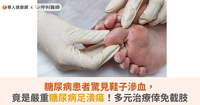 糖尿病患者驚見鞋子滲血，竟是嚴重糖尿病足潰瘍！多管齊下治療倖免截肢
