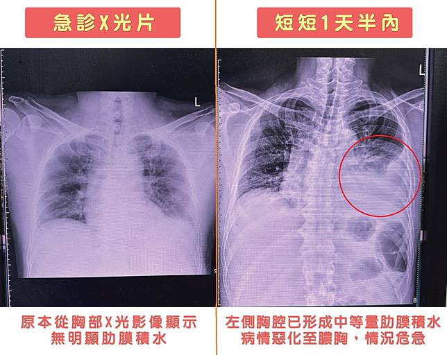 患者因突發性左側劇烈胸痛就醫，短短36小時內病情急速惡化，確診感染罕見「微小微單胞菌」並演變為膿胸。（圖／烏日林新醫院）