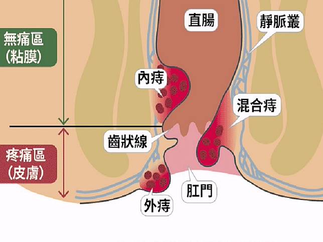 痔瘡的型態和種類。（圖：嘉基提供）
