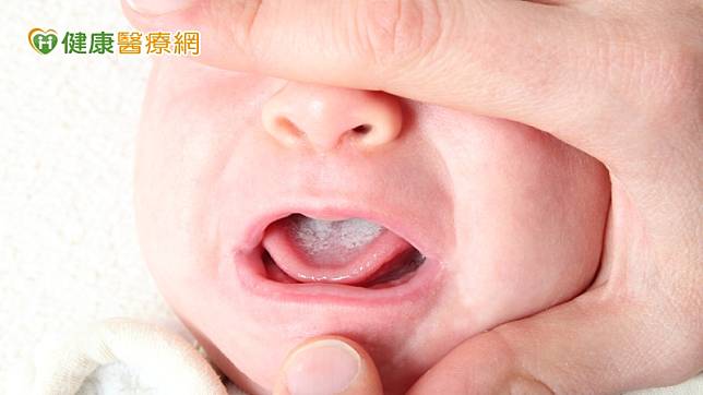 鵝口瘡為口腔內念珠菌感染所引起，大部份成因是寶寶出生時經過產道，接觸到媽媽皮膚表面的念珠菌而感染，因此好發於1歲前的寶寶，出生1個月後尤其是高峰期。
