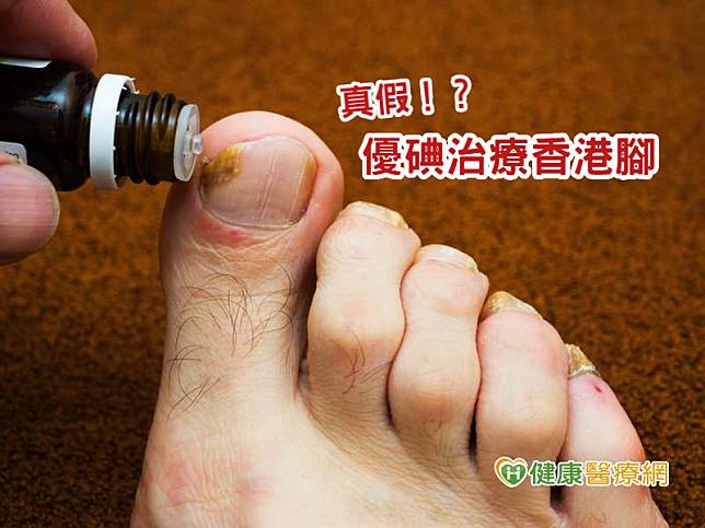 皮膚出現鱗屑、脫皮，而感到瘙癢難耐，若未經醫師指示自行使用優碘塗抹香港腳患處，恐過度刺激患部。