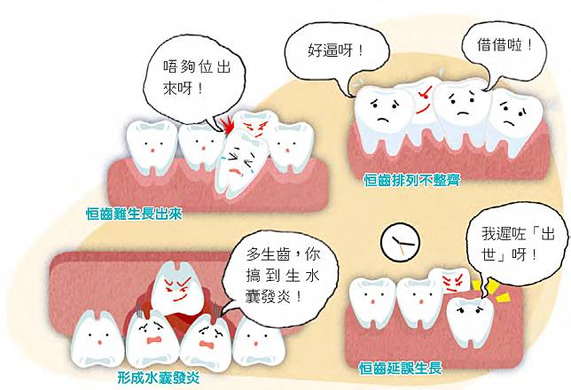 多齒症&ndash;成人有32隻恆齒，如發現多於32隻，便屬多齒症。如多生齒阻礙恆齒生長或因藏在牙骨內而形成水囊，便需要處理。（明報製圖）