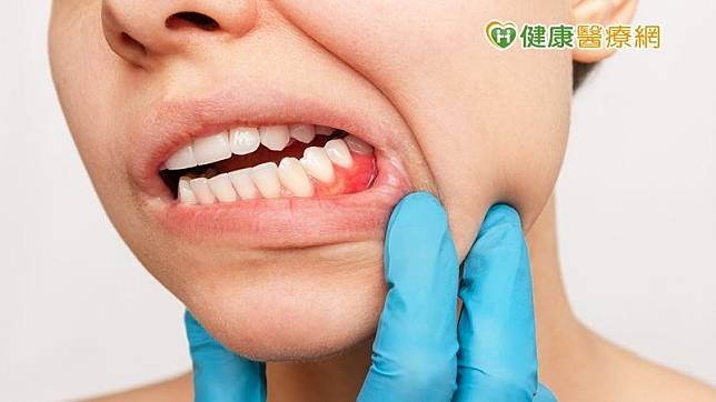 一旦牙齦紅腫出血，就要懷疑有可能是牙周病。