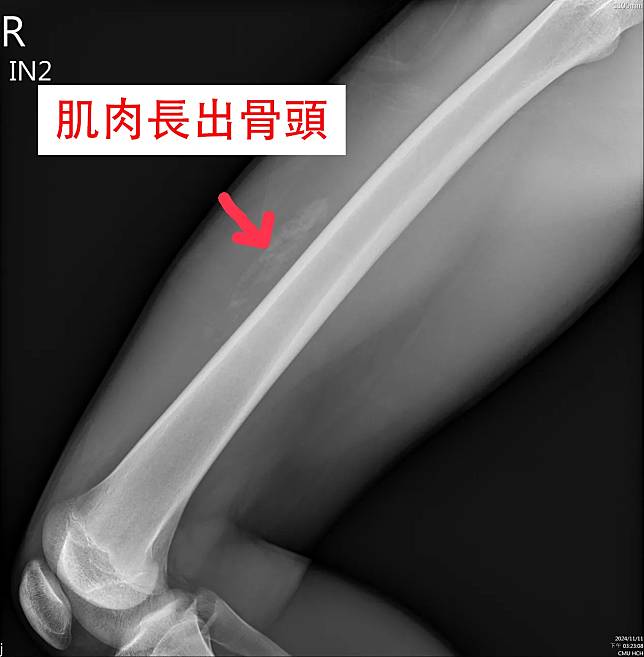 15歲籃球員肌肉挫傷竟長出「骨頭」。（圖／中醫大新竹附設醫院提供）