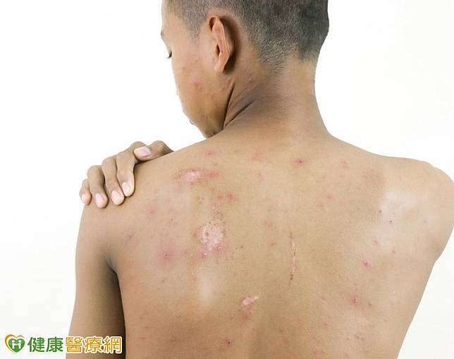 男紅疹刺痛　隱翅蟲、皮蛇治療大不同