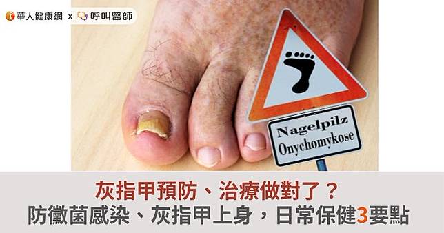 灰指甲預防、治療做對了？防黴菌感染、灰指甲上身，日常保健3要點