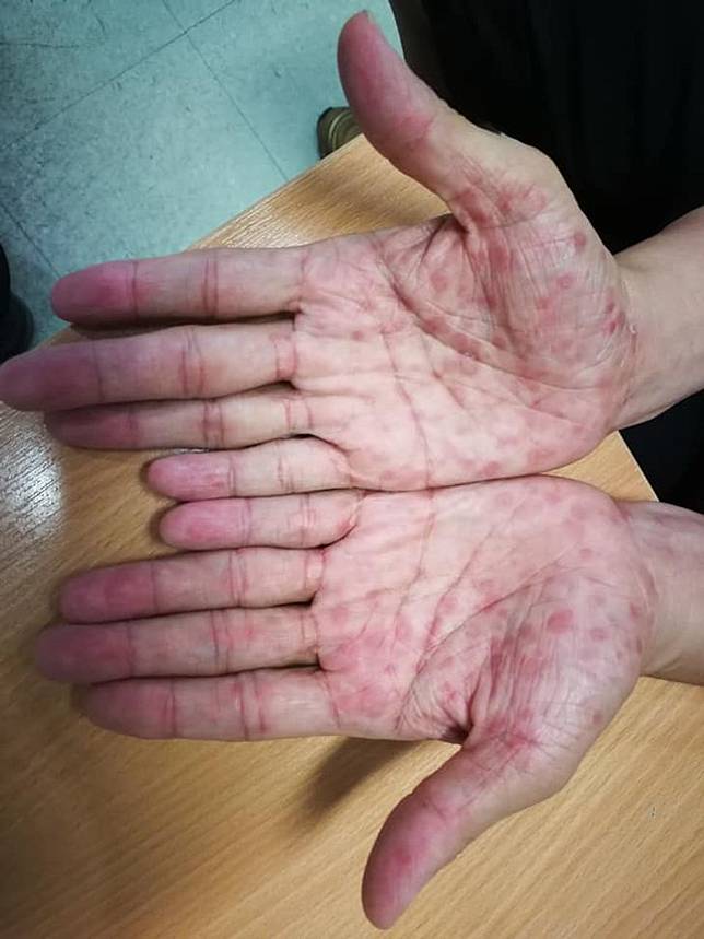 มือของผู้ป่วยซิฟิลิส