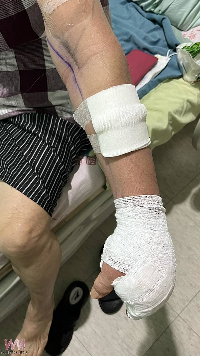 手碰吳郭魚竟釀嚴重感染險截肢　醫師示警北港類似案例已５起 - https://www.watchmedia01.com