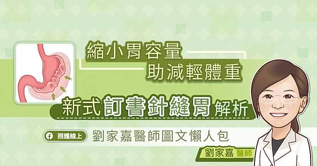 縮小胃容量助減輕體重，新式訂書針縫胃解析，劉家嘉醫師圖文懶人包