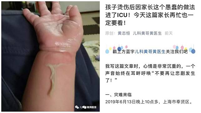 上海一名4歲男童日前不慎被燙傷，父親卻誤信偏方，在孩子傷口上淋上白酒，導致他傷勢加劇。(圖／翻攝自陸網)