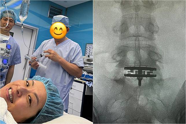 50歲徐濠縈椎間盤突出　手術前自拍：打噴嚏都會劇痛