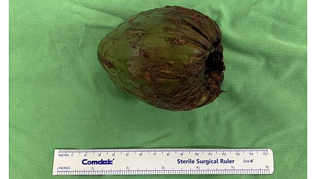 玩很大！高雄男「肛塞7.5公分椰子」，醫急剖腹驚「膀胱險破」。義大醫院提供
