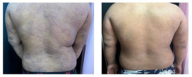 治療前軀幹呈現大面積苔蘚化病變(左)，治療後苔蘚化病變逐漸消失(右圖)，皮膚癢感也減輕許多。（新竹台大提供）