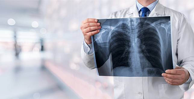肺癌也有「三高」：死亡率高、健保花費高、晚期發現比例最高！想顧肺，用「這招」1分鐘檢測肺功能