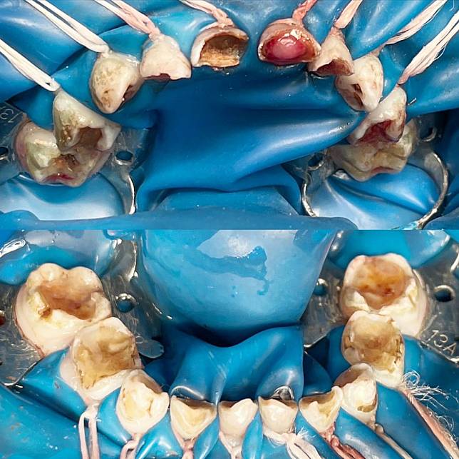 治療前，女童蛀牙狀況嚴重，上排門牙甚至已發炎生出肉芽。 （台北慈濟醫院提供）