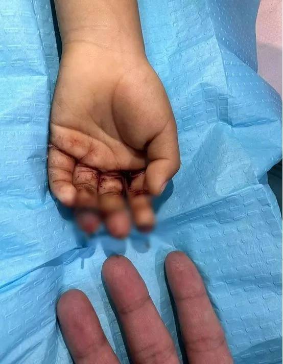 廣東婦煮飯兼顧不暇，一刀剁去4歲兒3隻手指。(微博)