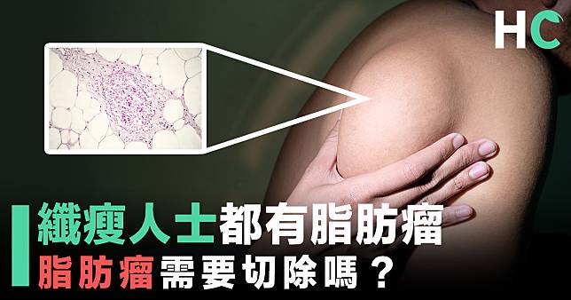 【了解病症】纖瘦人士都有脂肪瘤 脂肪瘤需要切除嗎？