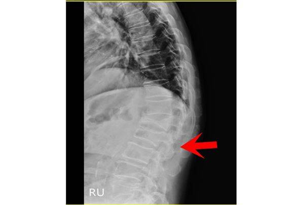 徐少克醫師筆指處即為百歲翁腰椎第一、第二節椎體變形位置（術後）。（圖片／童綜合醫院提供）