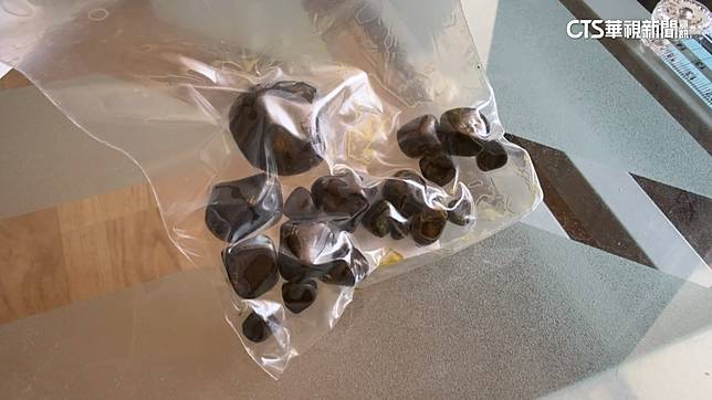 胃痛20年竟是膽結石！挖出18顆膽結石　最大2.3公分 | 