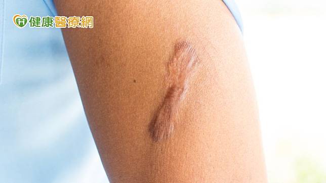 葉敬淳提到，好的傷口護理才能避免傷口感染或發炎，減少疤痕的機會。