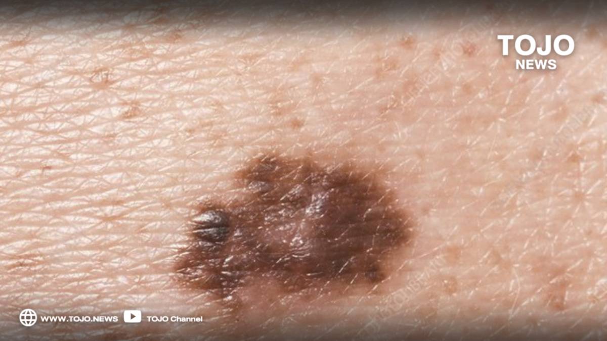 City Doctor Foundation Issues Warning on Signs of Melanoma Skin Cancer: Urgent Action Needed to Prevent Spread of Disease