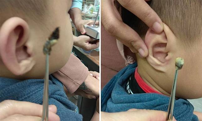醫生教你正確清理耳垢方法 | 3歲童疑失聰求醫 夾出2cm「巨型耳屎」