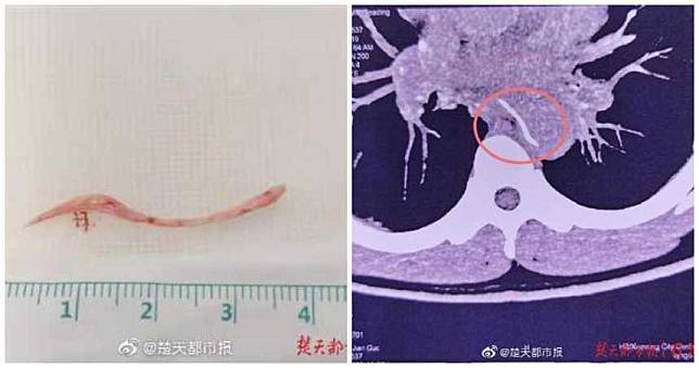 「吞飯嚥魚刺」插進主動脈命危　39醫接力開胸救命