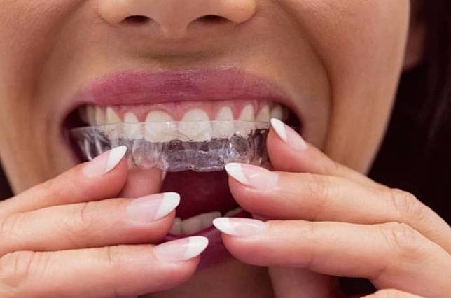 醫師提醒，若第1次矯正時間比較久，二次矯正要注意牙齦再萎縮或牙根再吸收，建議使用力量較溫和的隱形矯正；情境照。(圖取自freepik)
