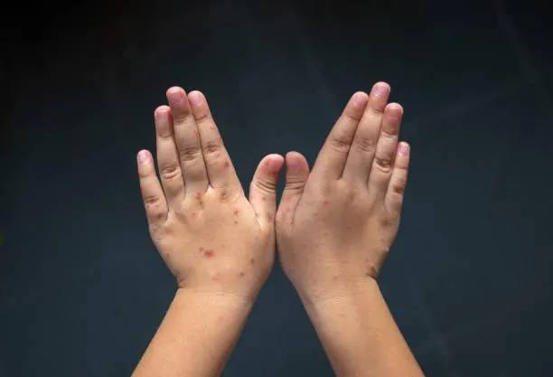 麻疹是具高度傳染性的空氣傳染病毒，主要影響對象是5歲以下的兒童。（示意圖／pixabay）
