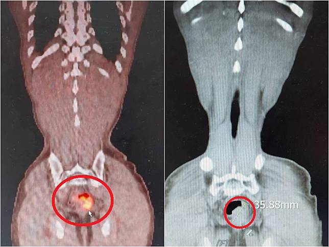 張先生經檢查發現在直腸有一約4公分的腫瘤（左圖紅圈處）；經正子造影檢查（右圖紅圈處），確認張先生沒有轉移，因此安排手術切除腫瘤。（大千醫院提供／呂麗甄苗栗傳真）