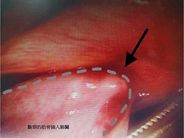 一位中年女性照護員，大白天走在道路被車輛撞成顏面骨折、顱內出血、鎖骨骨折、肱骨骨折、肋骨骨折等嚴重傷勢