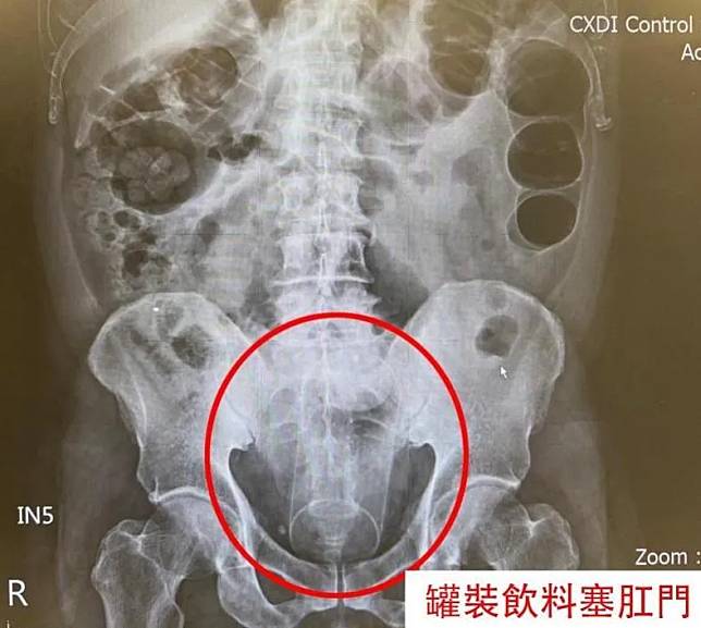 肛門塞13公分罐裝飲料。（圖／中國醫藥大學新竹附設醫院提供）