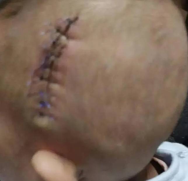 此前動手術取斷管失敗，孩子頭上留下長10公分疤痕。（圖／翻攝封面新聞）