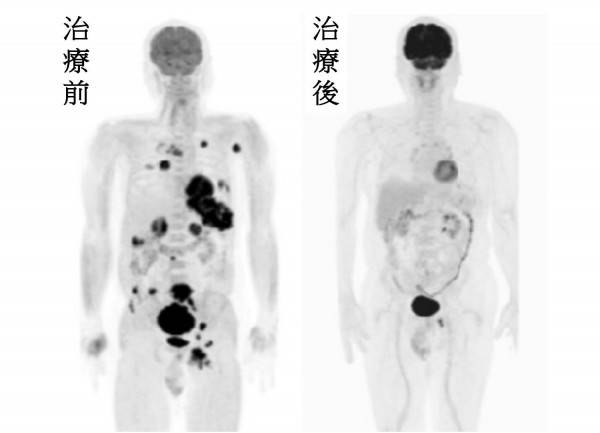 黃姓男子罹患「末期黑色素癌」，體內到處是黑色素癌腫瘤(左圖)；經「免疫檢查點抑制劑治療」治療後，末期黑色素癌腫瘤逐漸消失(右圖)。(記者陳建志翻攝)