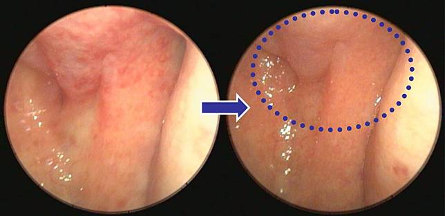 左圖為患者初診時，鼻咽黏膜紅腫且有潰瘍紅點；右圖，治療後黏膜潰瘍痊癒（圈圈處），不再出現「爆炸頭症候群」。 （陳建志醫師提供）