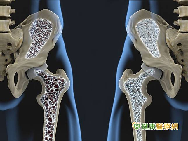 高雄榮民總醫院泌尿外科林仁泰主任表示，攝護腺癌是很常發生在國內老年男性的癌症，而骨頭是晚期攝護腺癌最常轉移的部位之一。