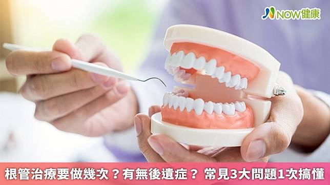 ▲根管治療又稱為牙髓病治療或齒內治療，也就是俗稱的抽神經，主要是透過移除牙齒牙髓腔內的感染來源，再以馬來膠作緻密的填充，以恢復牙根周圍的健康，並緩解牙齒的疼痛感。