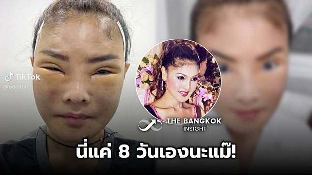 นี่แค่ 8 วันเองนะแม๊! อัปเดตภาพ ดาว มยุรี หลังศัลยกรรมดึงหน้า ไม่เชื่อก็ต้องเชื่อ