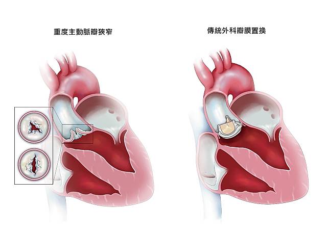 標準外科手術瓣膜置換示意圖。長庚醫院提供