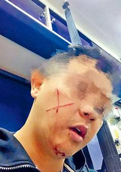 ■休班警長遇襲受傷，面頰有兩條交叉傷痕。　