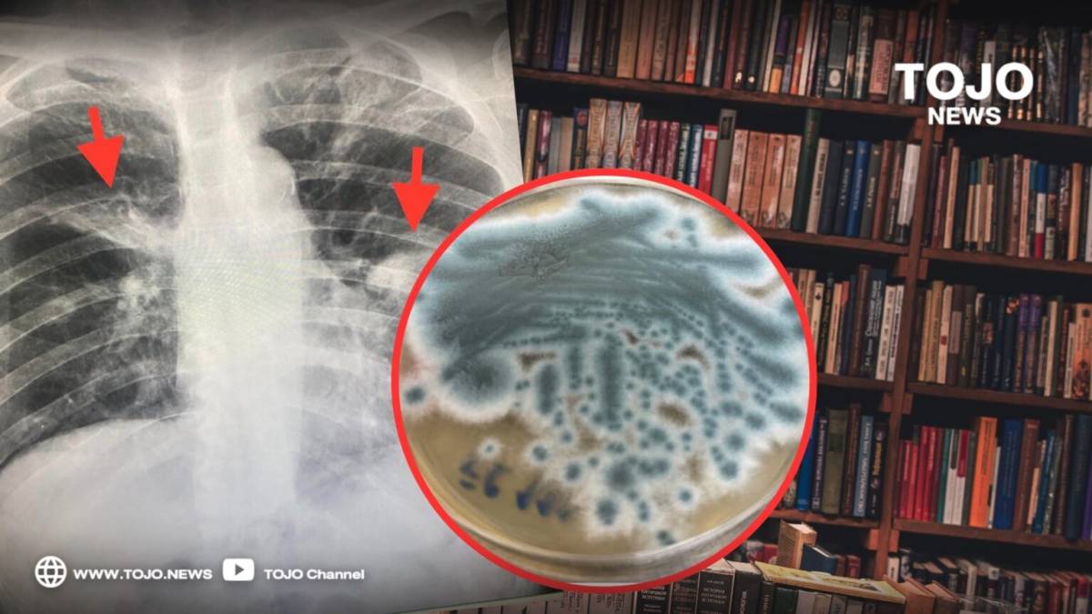 Hazard shut at hand!  Eradicating outdated books with out carrying a masks Fungal an infection within the lungs |