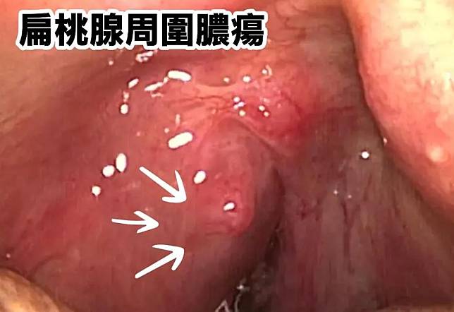 一名男子喉嚨劇痛，就醫診斷患有嚴重的「扁桃腺周圍膿瘍」。（圖／翻攝自「李典憲 耳鼻喉科醫師」）